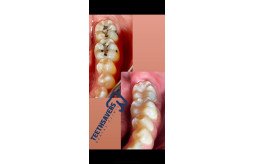 dental-implants-tijuana-small-0
