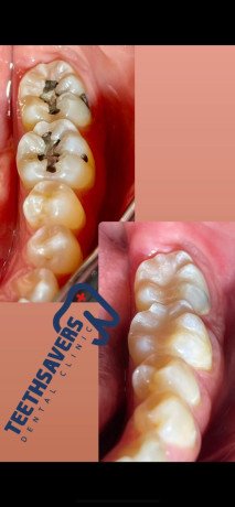 dental-implants-tijuana-big-0