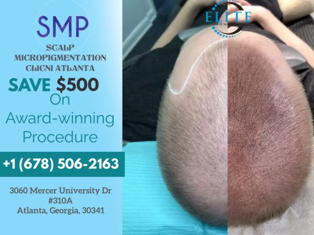 regain-your-lost-hairline-and-confidence-with-scalp-micropigmentationsmp-in-atlanta-big-3