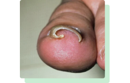 ingrown-toenail-near-me-small-0